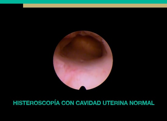 Histeroscopia