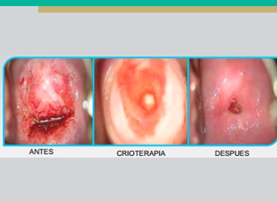 Tratamiento crioterapia