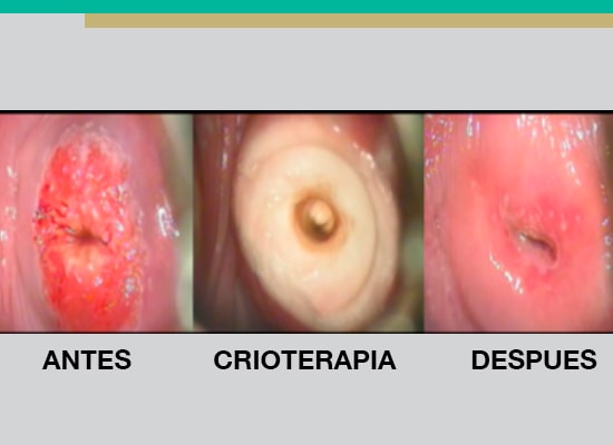 Tratamiento crioterapia