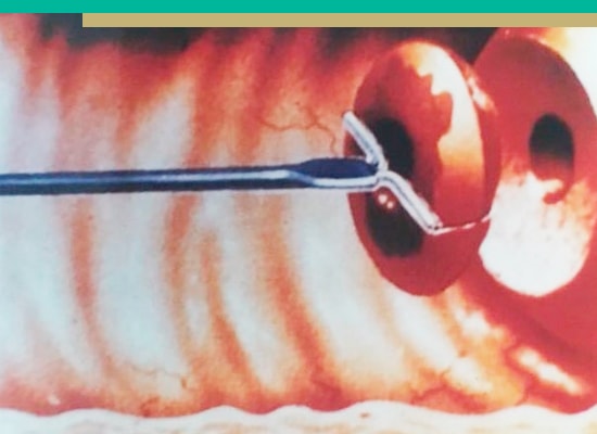 Tratamiento electrocirugia