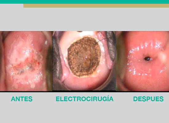 Tratamiento electrocirugia