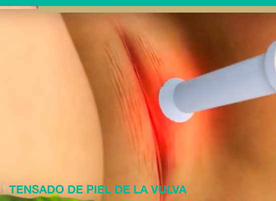 Tratamiento ginecología