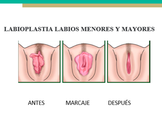 Tratamiento ginecología